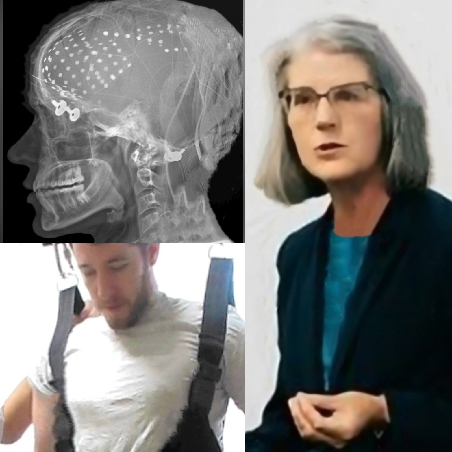 Dr Frincke and Michael MJ The Terrible Johnson Neurotech Brain Implant Photo Collage